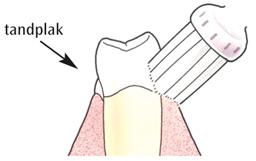Borstel schuin op het tandvlees